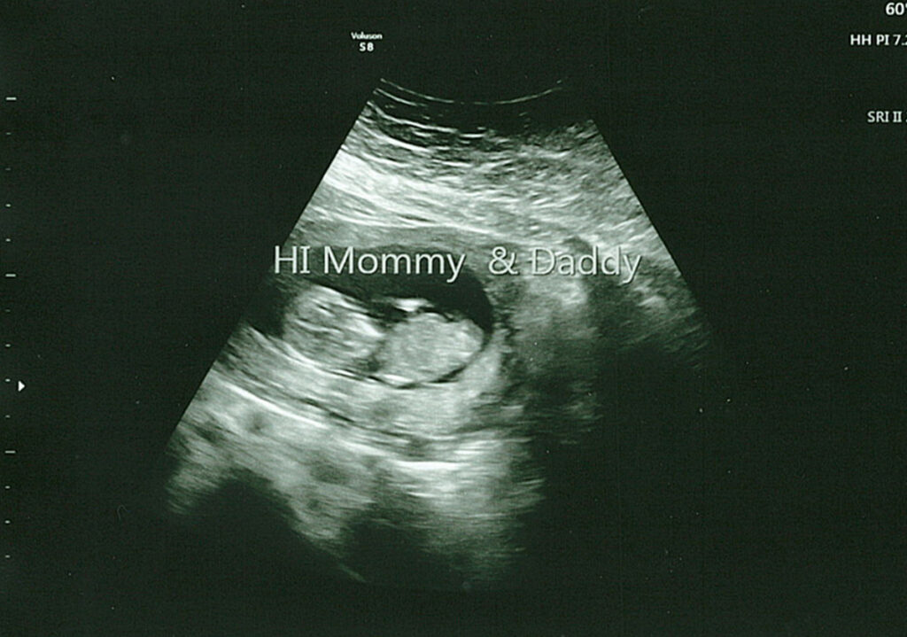 10 week ultrasound pictures