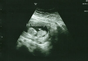 12 week baby ultrasound
