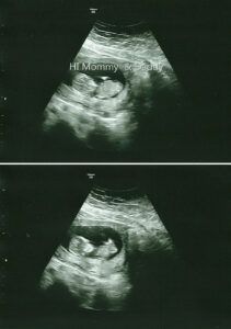 12 week baby ultrasound
