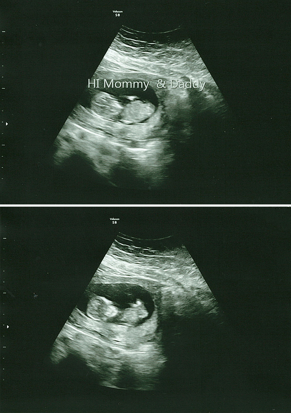 Our Amazing 12 Week Ultrasound (after recurrent pregnancy loss)