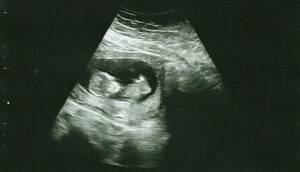 12 week baby ultrasound after experiencing miscarriages