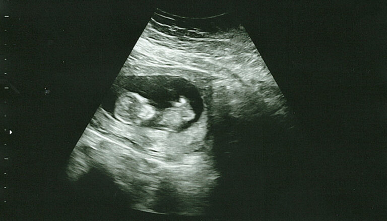 Our Amazing 12 Week Ultrasound (after recurrent pregnancy loss)