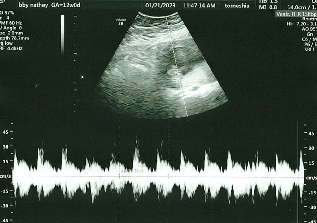 12 week baby ultrasound and heartbeat