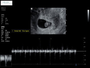 7 week baby ultrasound